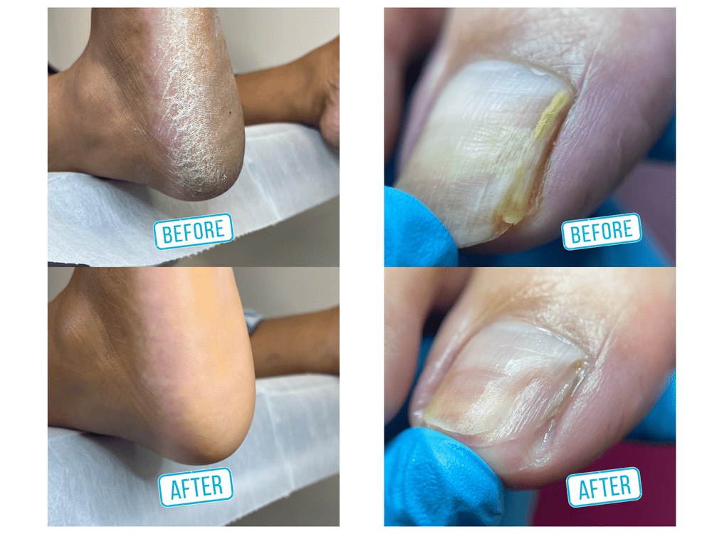 Before and after examples of professional foot care