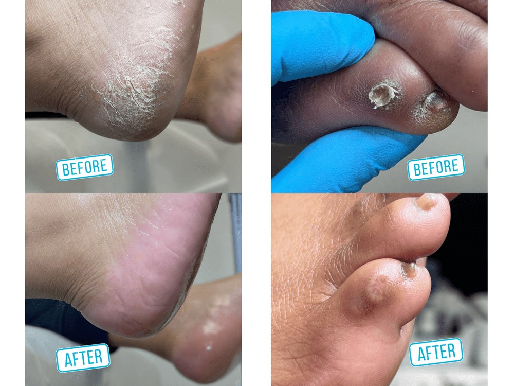 Before and after examples of professional foot care