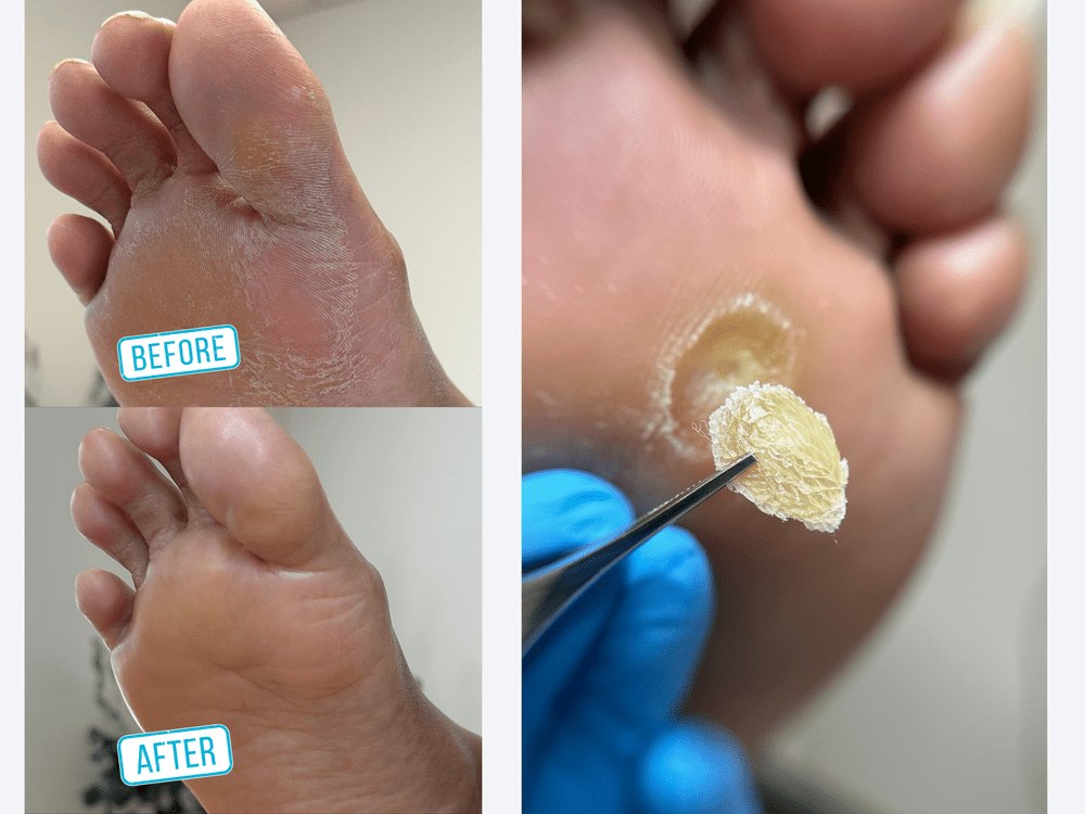 Before and after examples of professional foot care